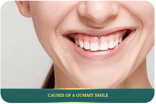 Gummy Smile Treatment 2 Causes of a gummy smile