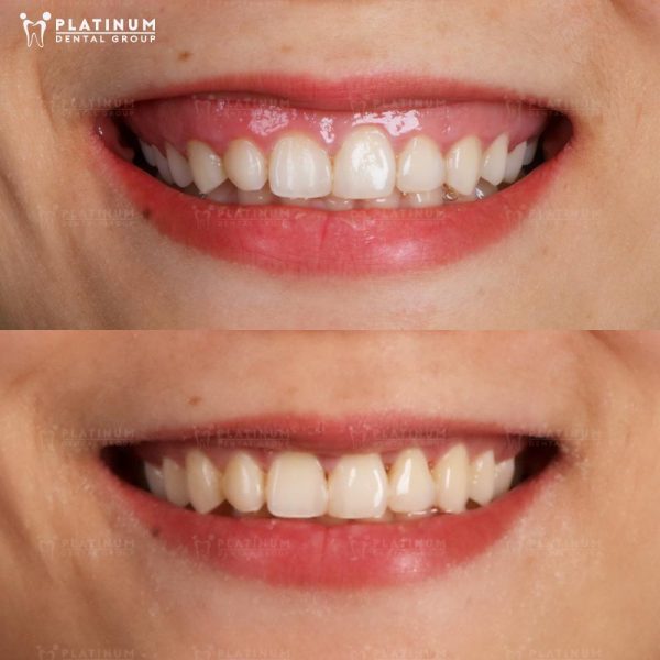 Gummy Smile Treatment 6 Platinum Dental Group corrected a gummy smile with painless laser gum contouring for a longer, more aesthetic smile