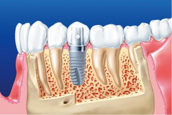 What benefits of immediate implant placement?