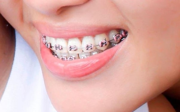 Các phương pháp nâng khớp cắn