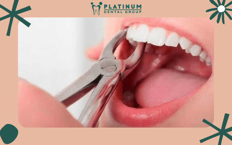 Liệu Niềng Răng Có Phải Nhổ Răng Không? Nha Khoa Niềng Răng Uy Tín 1 nieng rang co phai nho rang 01