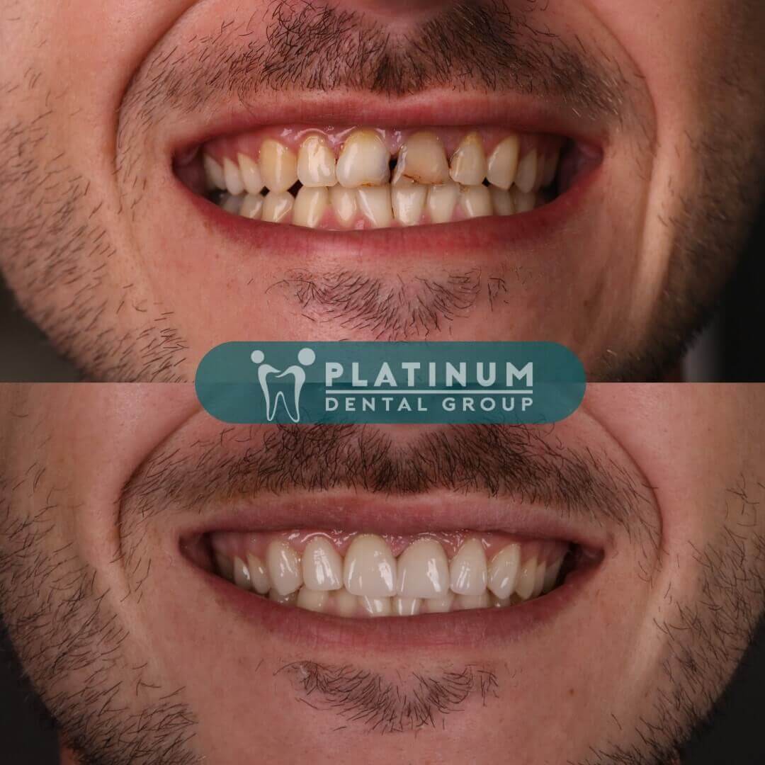 Top 3 best dental crown materials 2023