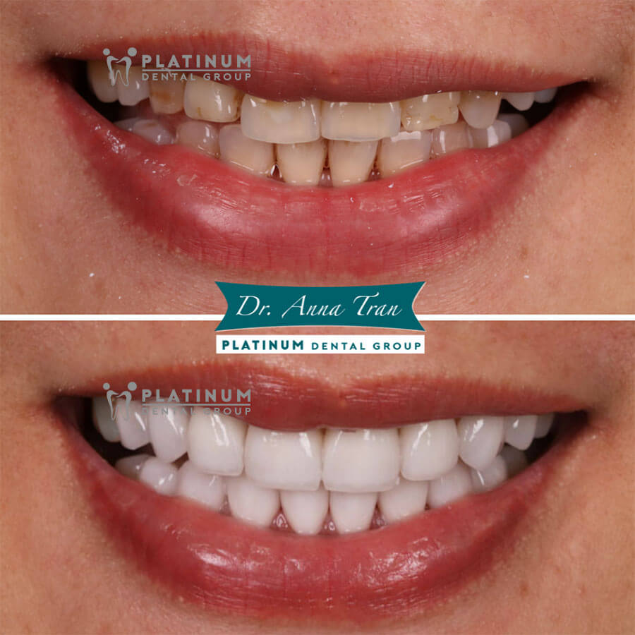 Top 3 best dental crown materials 2023