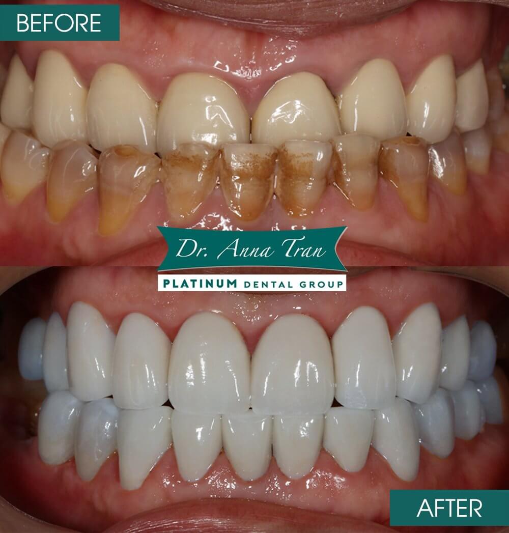 Top 3 best dental crown materials 2023