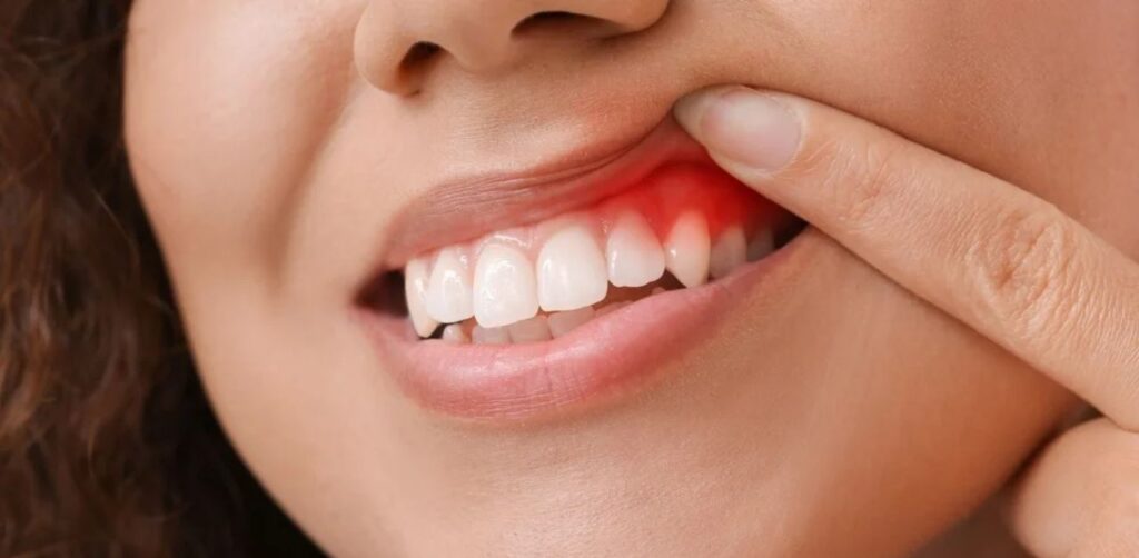 Viêm Chân Răng Có Mủ Điều Trị Như Thế Nào? 1 Viêm Chân Răng Có Mủ Điều Trị Như Thế Nào?