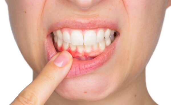 Viêm Chân Răng Là Gì? Khi Bị Viêm Chân Răng Nên Làm Gì? 23 Viêm Chân Răng Là Gì? Khi Bị Viêm Chân Răng Nên Làm Gì?