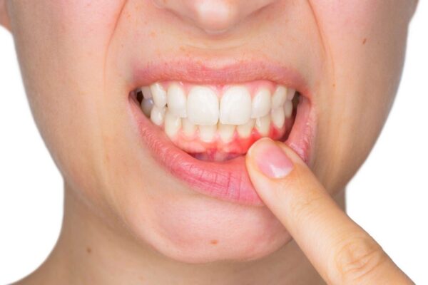 Viêm Nướu Răng: Nguyên Nhân - Triệu Chứng Và Cách Phòng Tránh 27 Viêm Nướu Răng - Cách Nhận Biết Và Điều Trị Hiệu Quả