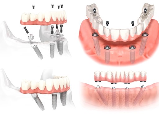 All on 4 dental implants removable? - All on 4 Dental Implants with Platinum Dental