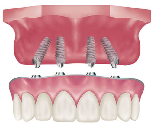 How All On 4 Dental Implants Work? All on 4 dental implants removable?