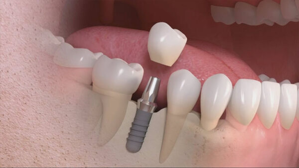 All on 4 dental implants removable?