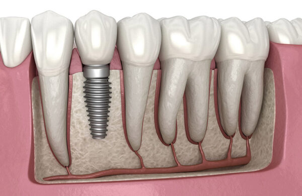 Cases should and should not implant All On 6 Implant