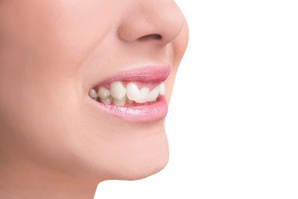 Causes of crooked teeth: The arch size is smaller than the size of the permanent teeth