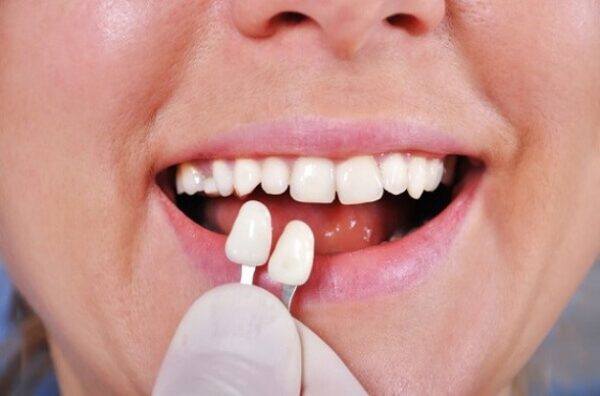 Causes of crooked teeth and Porcelain veneers for crooked teeth