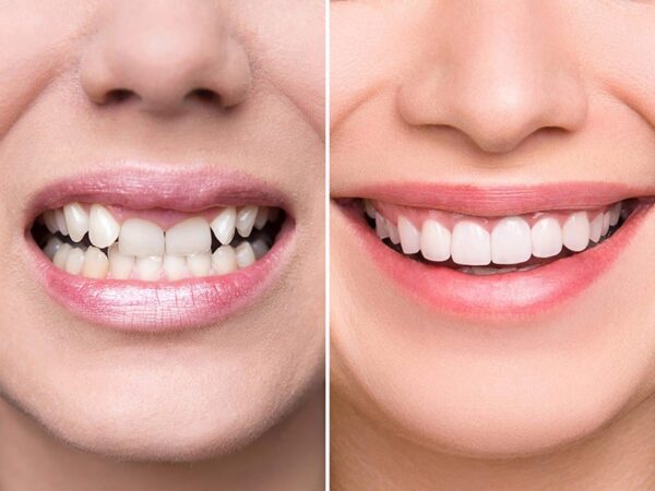Causes of crooked teeth & Reputable crooked orthodontic address