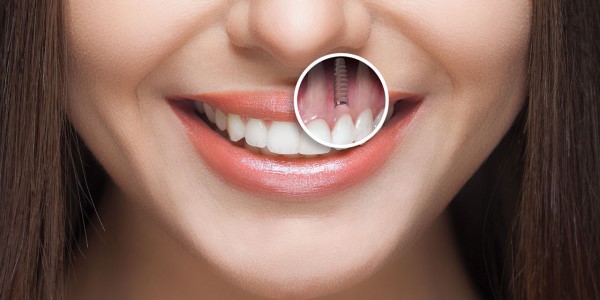 How to select the best option for dental implant?