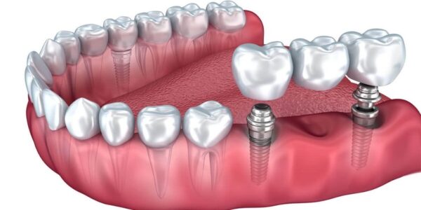 Dentist can choose the best implant for your needs