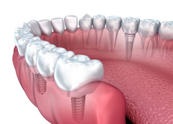 Platinum Dental implant dentist is a key decision for your implant option 