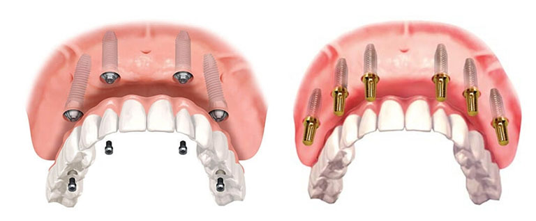 All-On-4 vs All-On-6 Dental Implants - Which One is More Suitable for You?