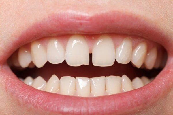 Which method is the safest and most effective way to fill a gap between teeth?