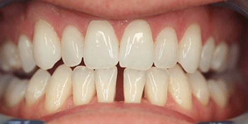 Can a dentist fill a gap between teeth?