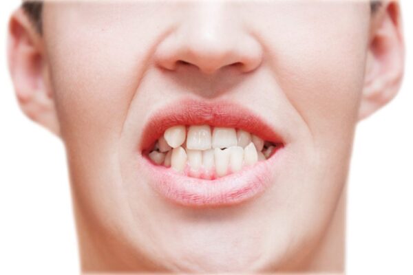 Porcelain teeth may be a viable alternative to crooked braces