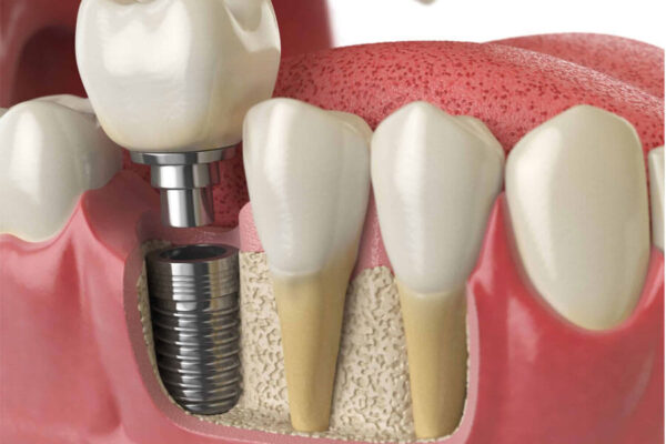 When is a dental implant procedure necessary?