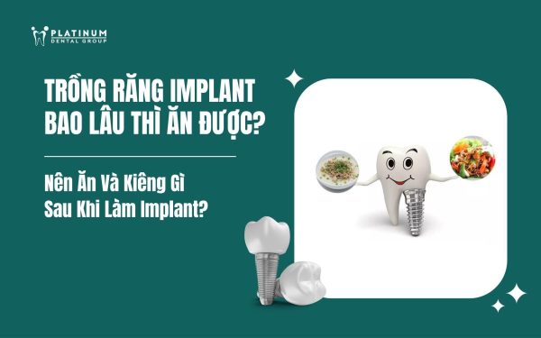 trồng răng Implant bao lâu thì ăn được