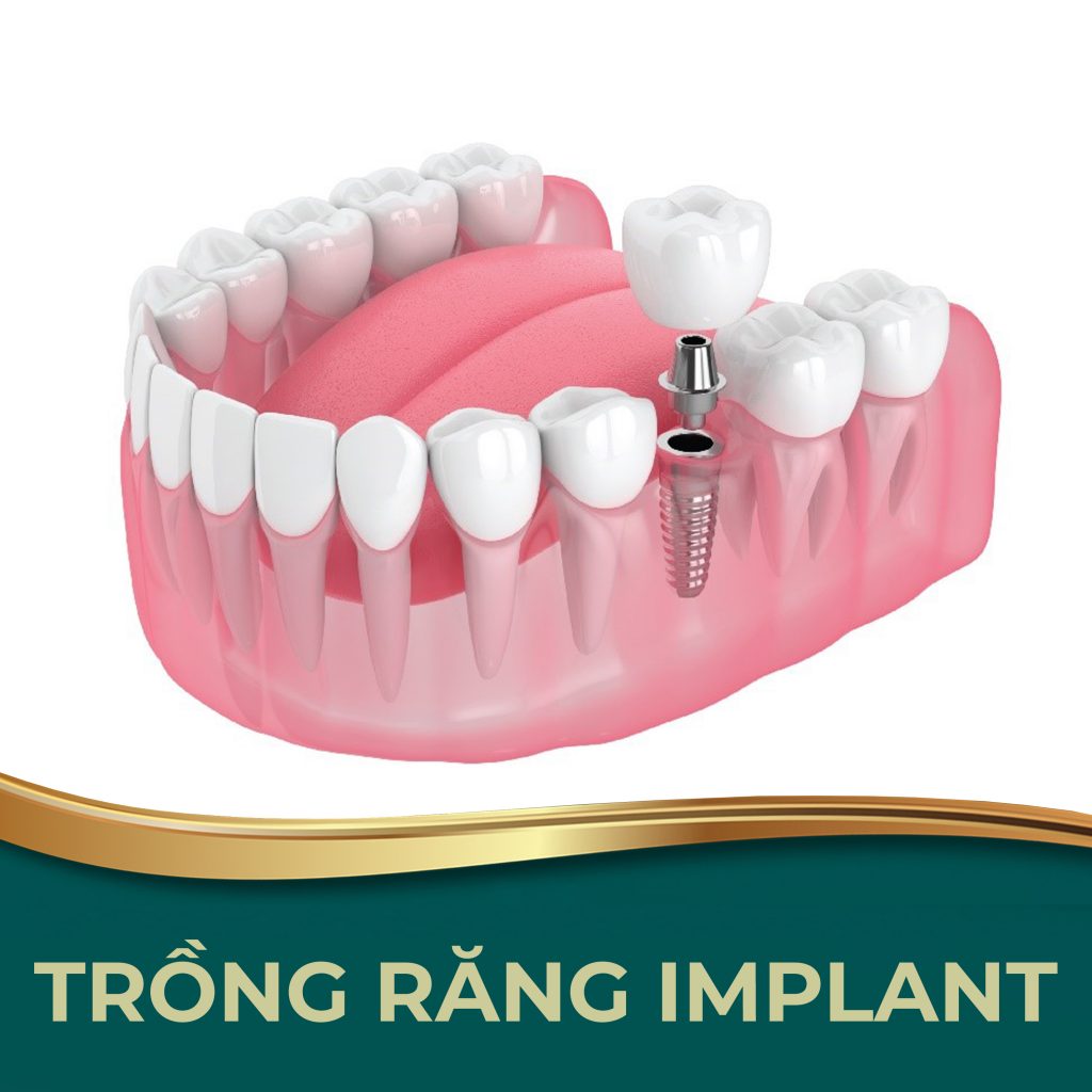 Chi Phí Trồng Răng Implant Mới Nhất Năm 2023