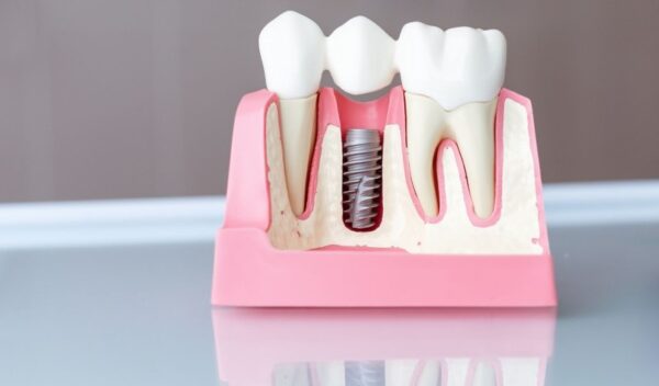 Who can use dental implants?
