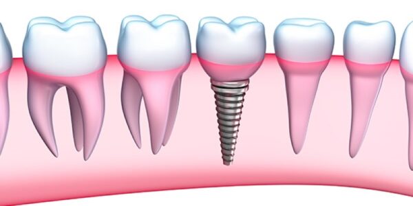 What is the process of getting dental implants overseas?