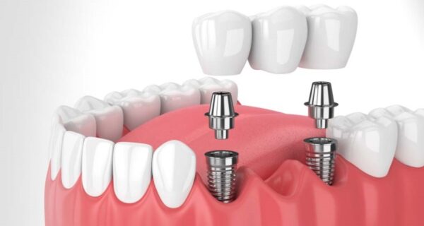 The purpose of dental implants