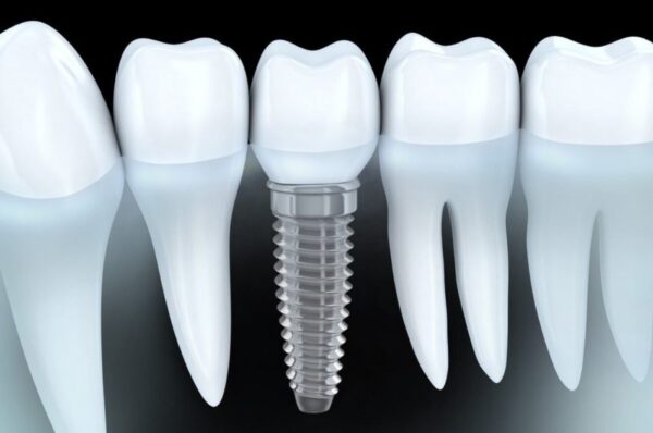 Factors affecting the lifespan of dental implants