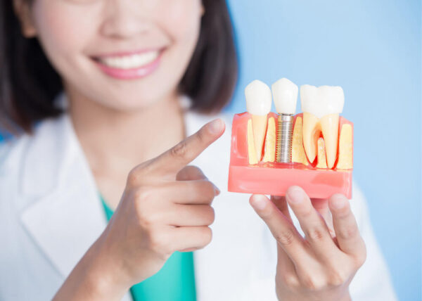 How to maintain your Dental Implants?