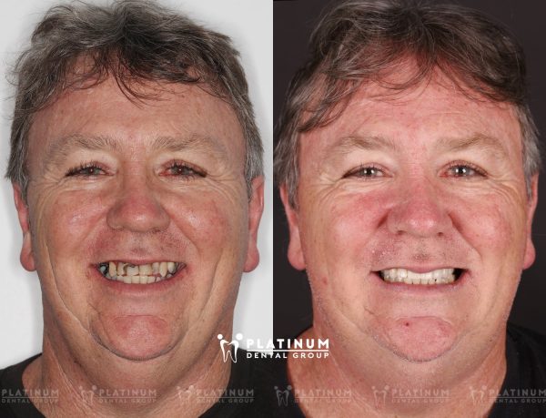 Extend the life of your dental Implants: consistent oral hygiene and regular dental checkups are essential for decades of healthy, functional teeth