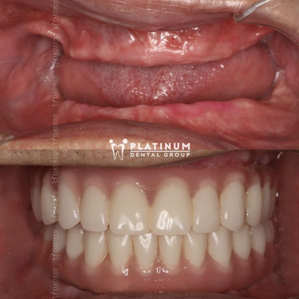 Why patients choose Platinum Dental Group for dental Implants