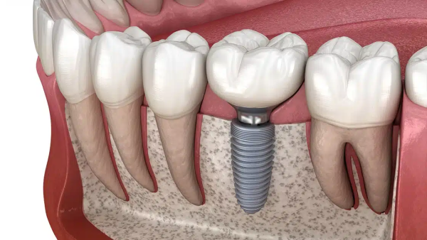 Patient health and lifestyle play a key role in dental Implant longevity. Managing chronic conditions, maintaining a balanced diet, and avoiding smoking help ensure long-lasting results