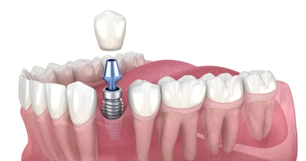 Dental Implants can last decades with proper care