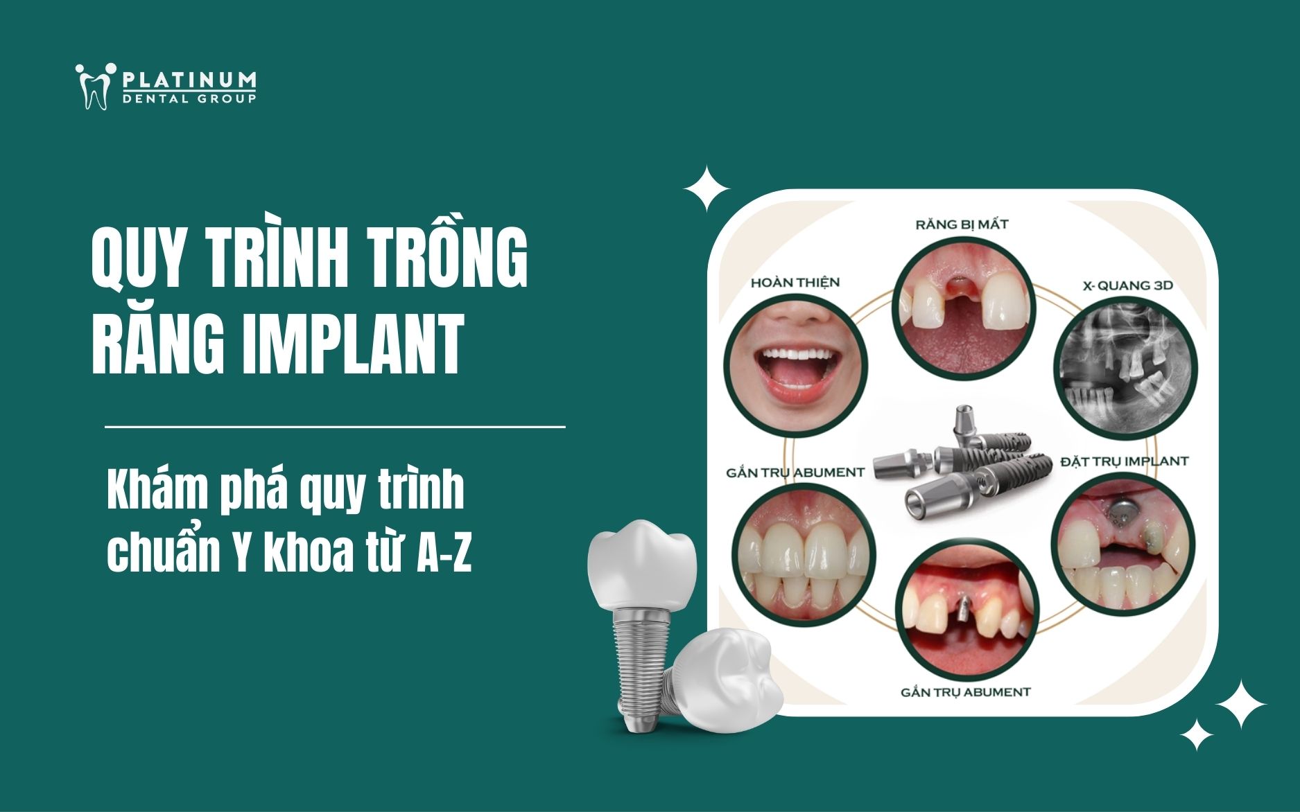 Khám phá quy trình trồng răng Implant chuẩn từ A-Z