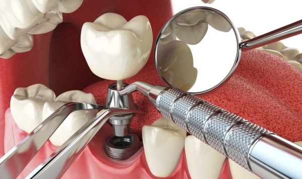 Khám phá quy trình trồng răng Implant chuẩn từ A-Z 3 Gắn mão sứ khi trụ Implant đã tích hợp chắc chắn với xương