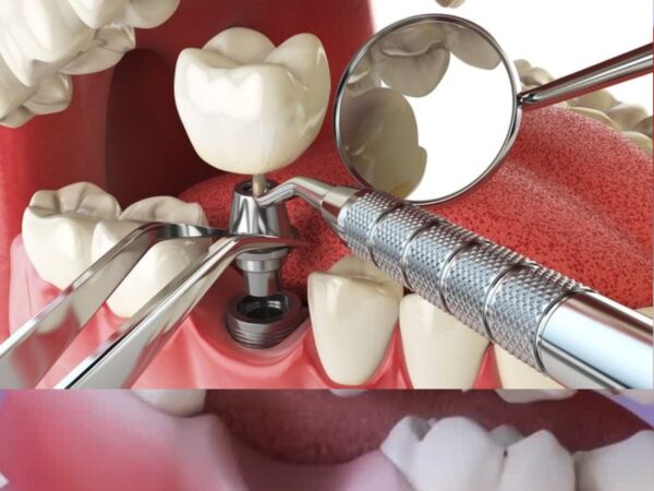 Khám phá quy trình trồng răng Implant chuẩn từ A-Z 3 Gắn mão sứ khi trụ Implant đã tích hợp chắc chắn với xương