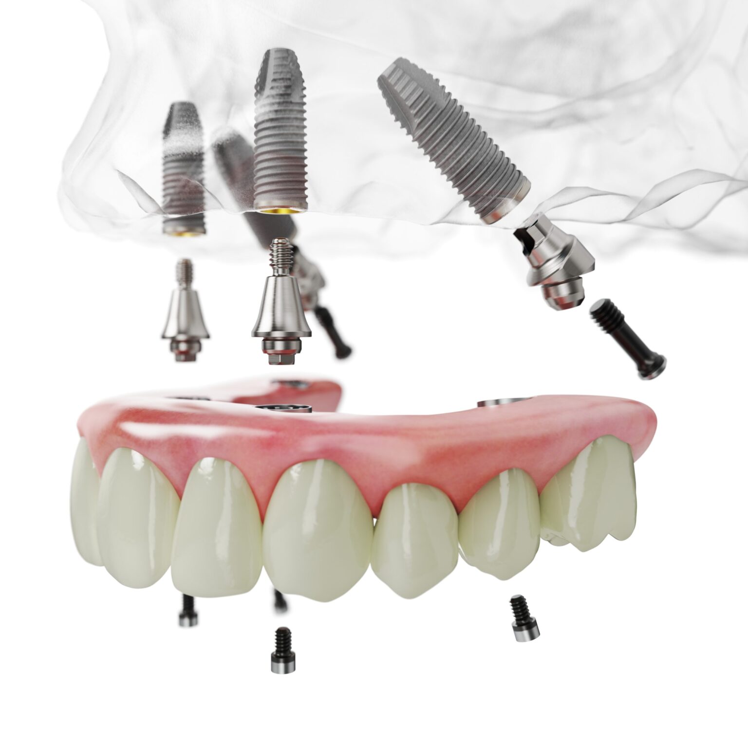 Tiến hành phẫu thuật trồng implant toàn hàm
