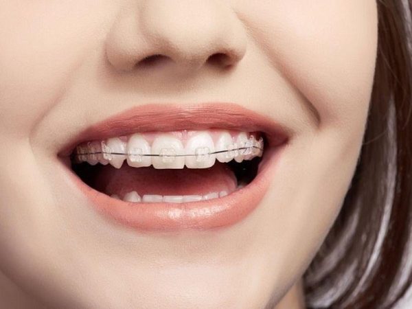 Bảng giá niềng răng mắc cài sứ mới nhất và 3+ yếu tố ảnh hưởng 2 Trường hợp răng đơn giản thì giá niềng răng mắc cài sứ sẽ tối ưu hơn