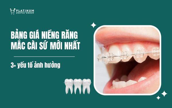 giá niềng răng mắc cài sứ