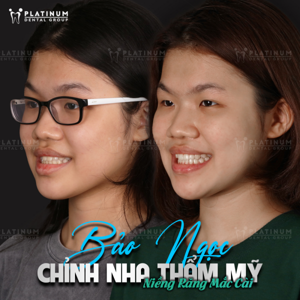 Nên niềng răng trong suốt hay mắc cài? Hướng dẫn chọn phương pháp phù hợp 4 Niềng răng mắc cài có hiệu quả chỉnh nha cao