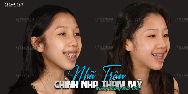 Nên niềng răng trong suốt hay mắc cài? Hướng dẫn chọn phương pháp phù hợp 6 Răng lệch lạc nghiêm trọng, khớp cắn phức tạp nên niềng răng mắc cài