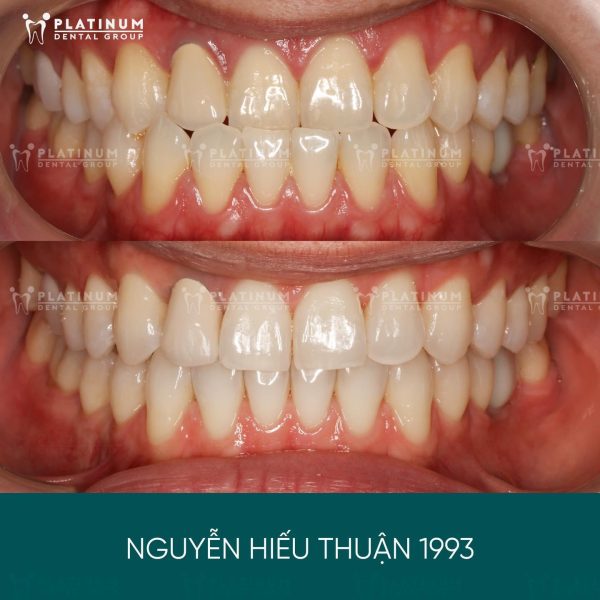 Nên niềng răng trong suốt hay mắc cài? Hướng dẫn chọn phương pháp phù hợp 8 Một ca niềng răng trong suốt được thực hiện tại Platinum Dental Group
