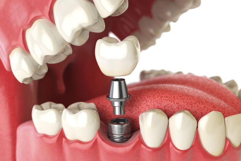Can dental implant cause ear pain? How to fix that symptom?