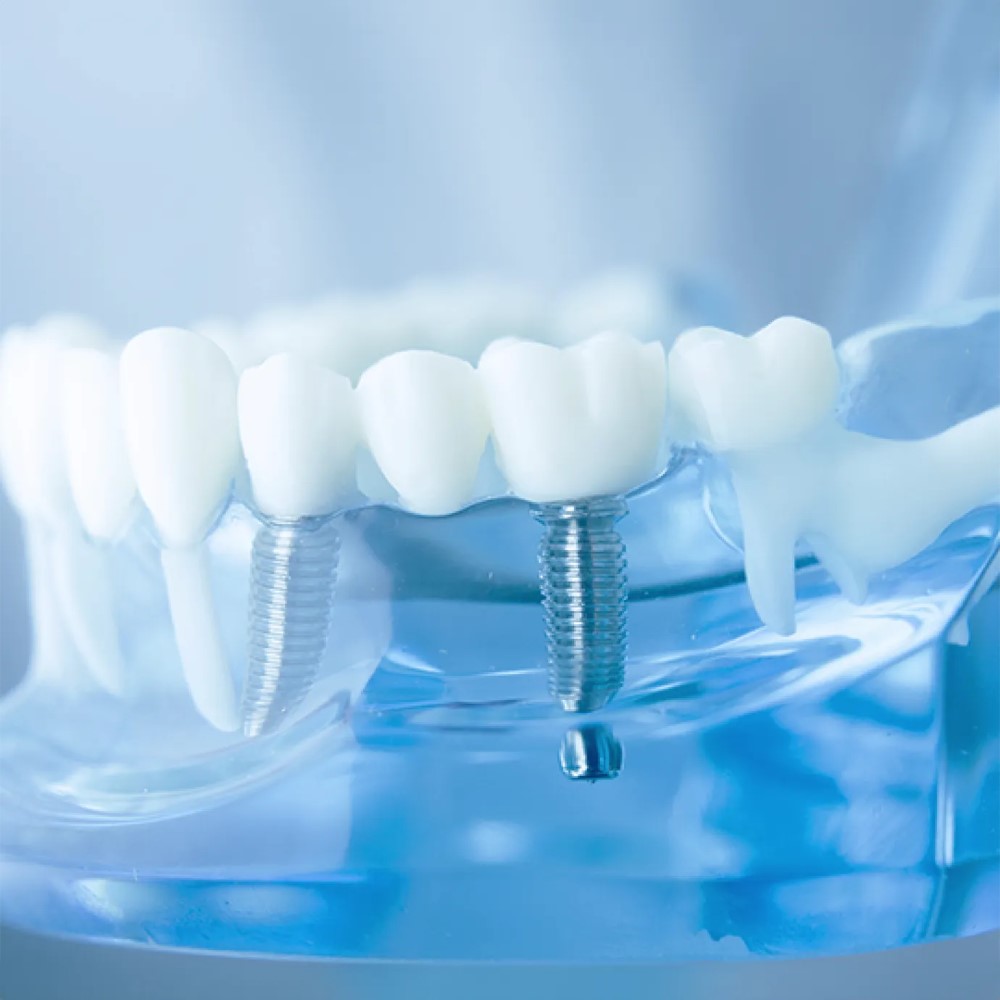 Types of Dental Implant Emergencies