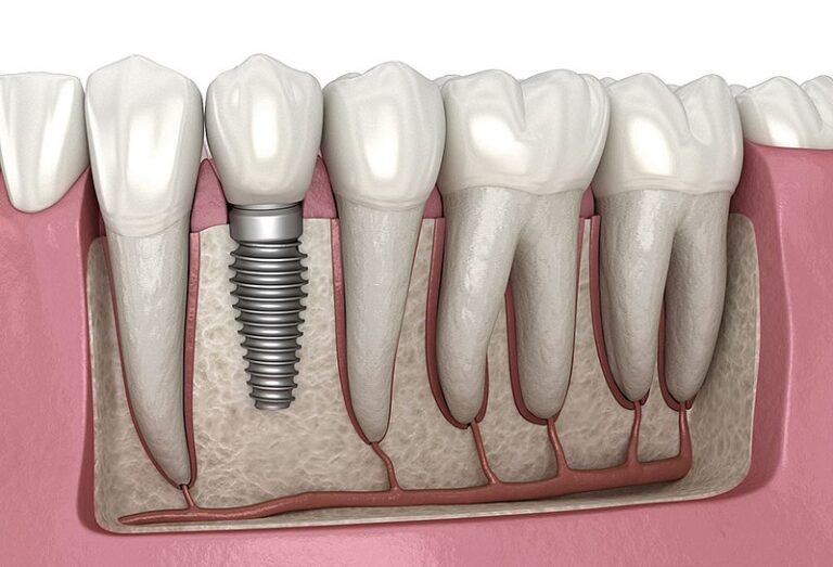 What should I do when my dental implant fell out? Platinum Dental Group