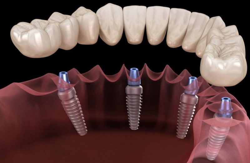 Signs of loose dental implants
